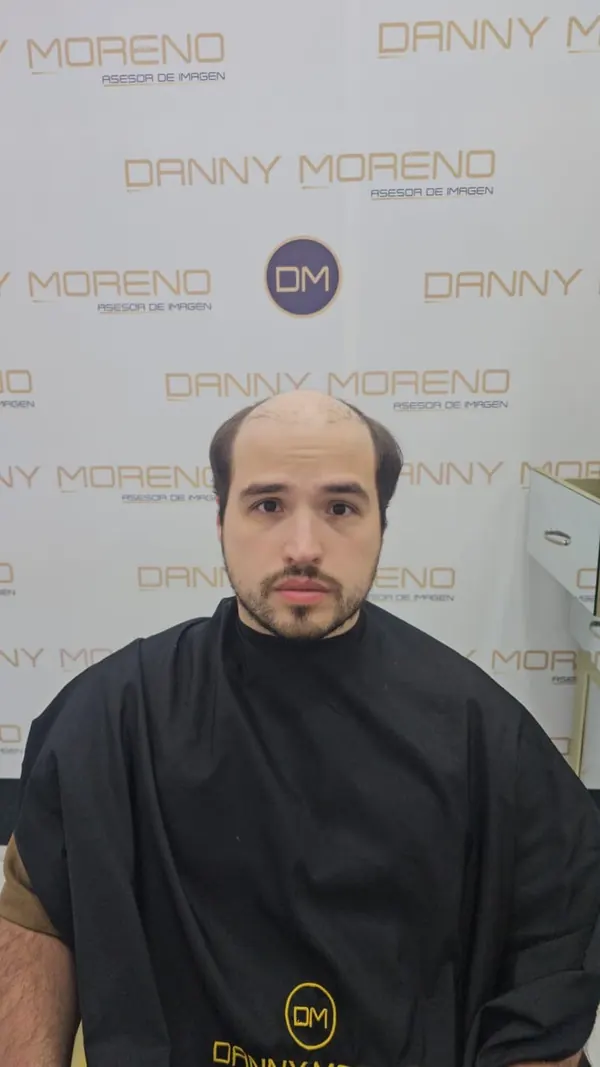 Antes: coronilla y entradas